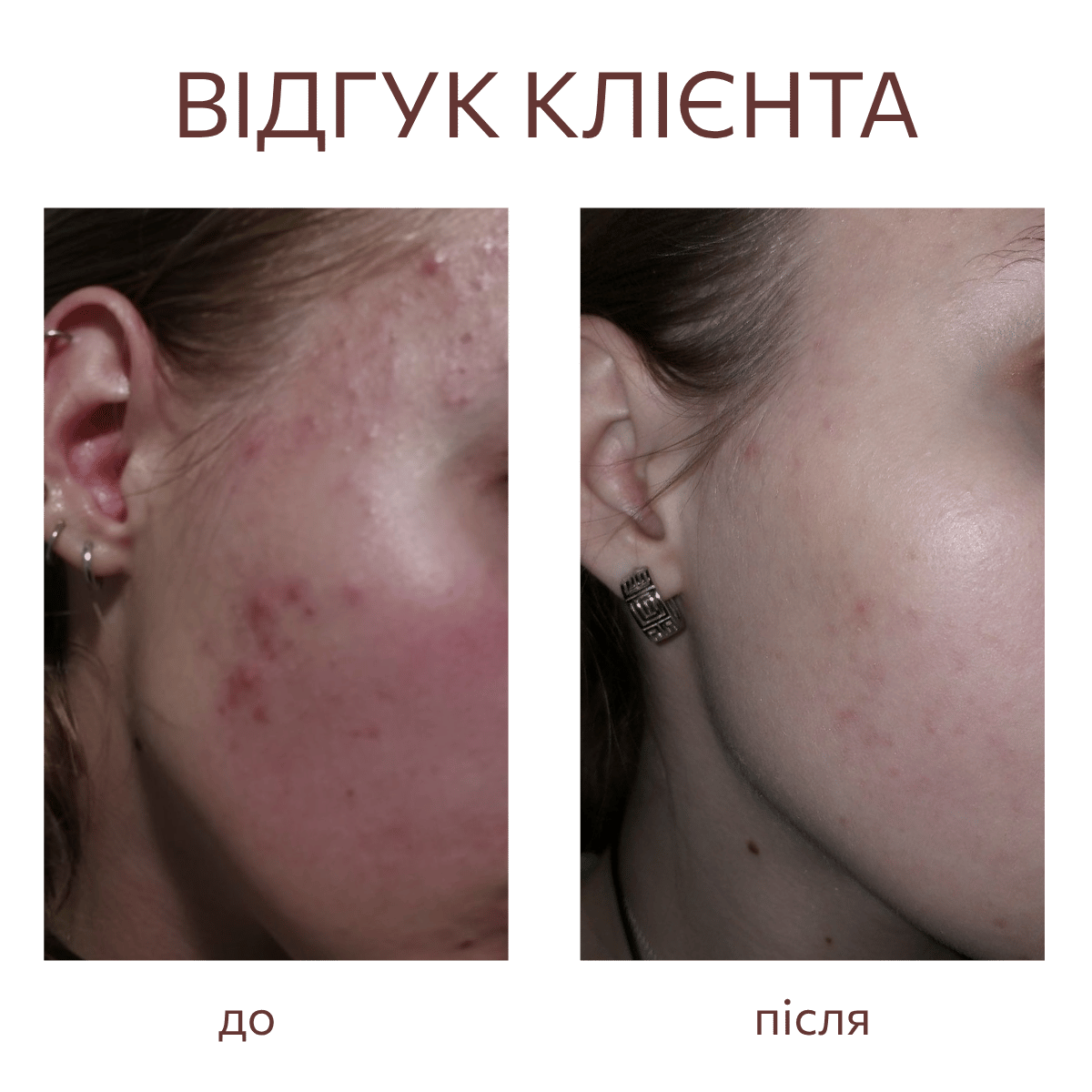 SOS-SERUM сироватка проти висипань та чорних цяток
